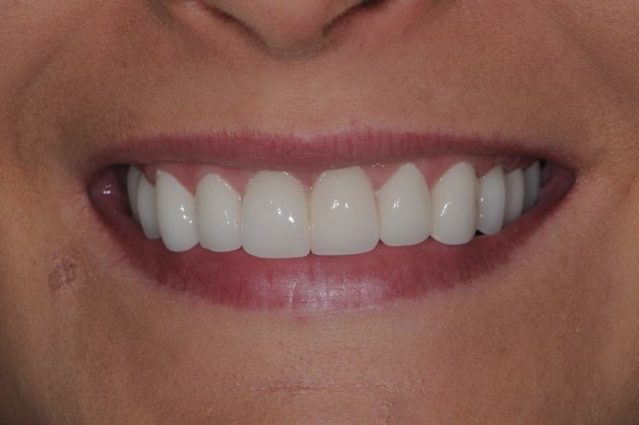 Gallery 3 - Whiten Teeth For Charity
